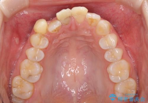 転んで前歯が欠けた 折れた前歯をきっかけに矯正治療で歯列をきれいに整えるの治療前