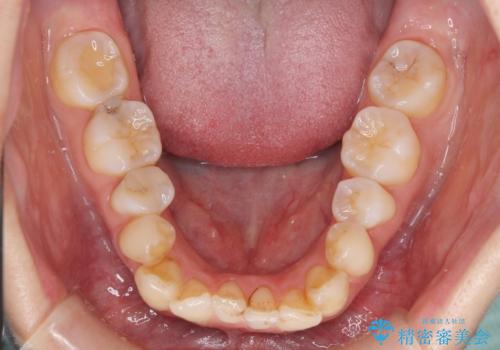 転んで前歯が欠けた 折れた前歯をきっかけに矯正治療で歯列をきれいに整えるの治療前