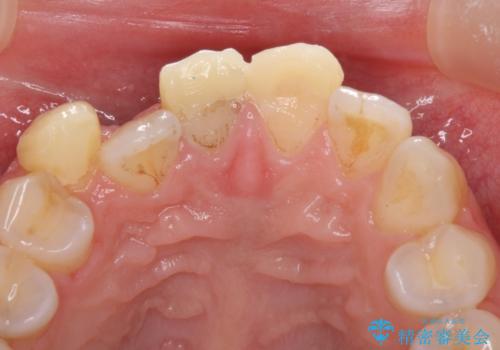 転んで前歯が欠けた 折れた前歯をきっかけに矯正治療で歯列をきれいに整えるの治療前