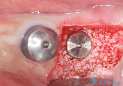 歯がぐらぐらで咬めない 奥歯のインプラント 50代男性の治療中