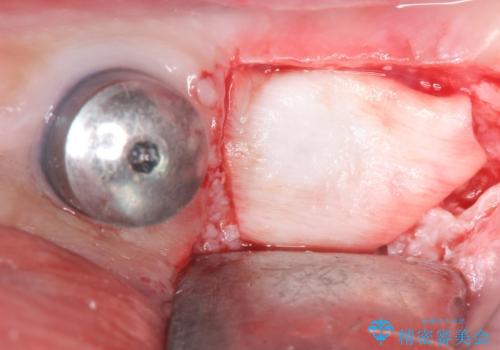 歯がぐらぐらで咬めない 奥歯のインプラント 50代男性の治療中