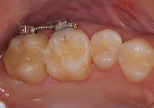 奥歯の虫歯 歯の間を広げてセラミックでしっかり治療の治療中