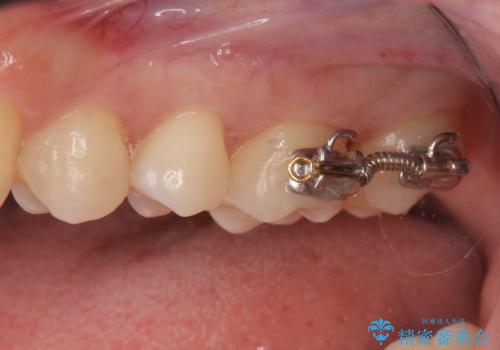 奥歯の虫歯 歯の間を広げてセラミックでしっかり治療の治療中