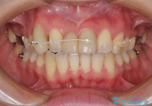 転んで前歯が欠けた 折れた前歯をきっかけに矯正治療で歯列をきれいに整えるの治療中
