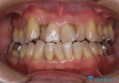 全体的な治療の開始前に着色取りの治療後