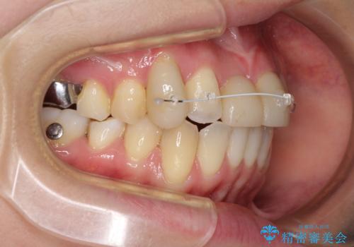 転んで前歯が欠けた 折れた前歯をきっかけに矯正治療で歯列をきれいに整えるの治療中