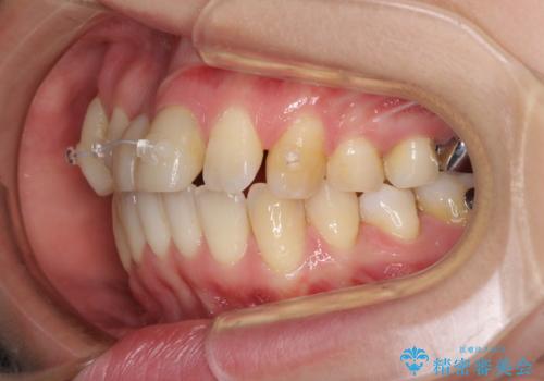 転んで前歯が欠けた　折れた前歯をきっかけに矯正治療で歯列をきれいに整えるの治療中