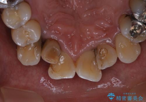 全体的な治療の開始前に着色取りの症例 治療後