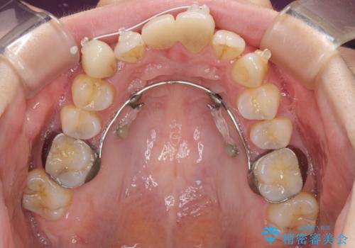 転んで前歯が欠けた 折れた前歯をきっかけに矯正治療で歯列をきれいに整えるの治療中