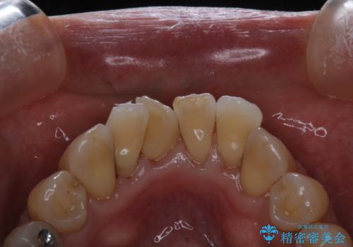 全体的な治療の開始前に着色取りの治療後