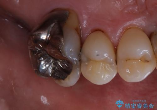 全体的な治療の開始前に着色取りの治療後