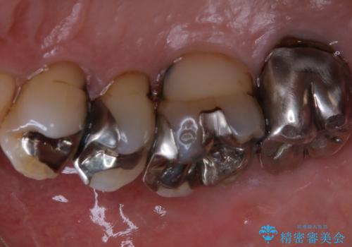 全体的な治療の開始前に着色取りの治療後