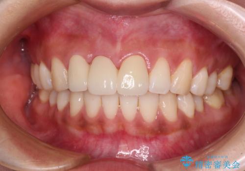 折れているのに応急処置でごまかしてきた前歯 オールセラミックブリッジによる補綴治療の治療後