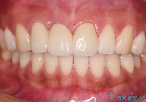 折れているのに応急処置でごまかしてきた前歯 オールセラミックブリッジによる補綴治療の治療後