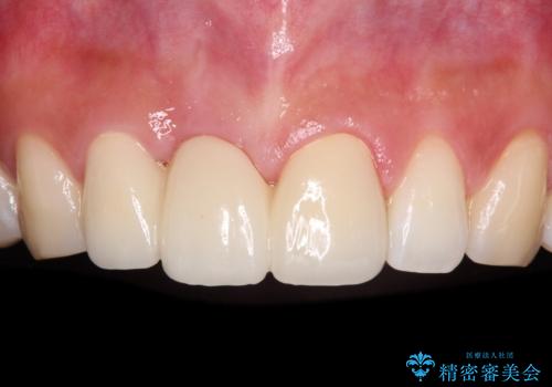 折れているのに応急処置でごまかしてきた前歯 オールセラミックブリッジによる補綴治療の治療後