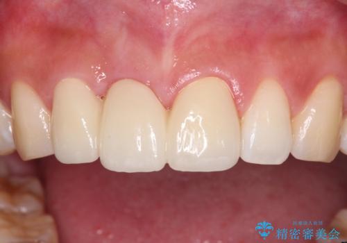 折れているのに応急処置でごまかしてきた前歯 オールセラミックブリッジによる補綴治療の治療後