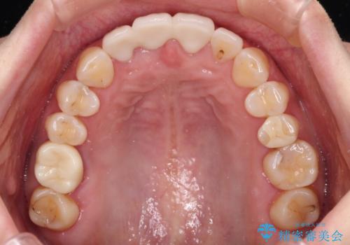 折れているのに応急処置でごまかしてきた前歯 オールセラミックブリッジによる補綴治療の治療後
