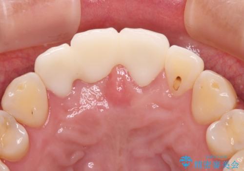 折れているのに応急処置でごまかしてきた前歯 オールセラミックブリッジによる補綴治療の治療後