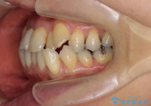 [ 矯正と補綴、総合歯科治療 ]  クロスバイトを避ける前歯部審美ブリッジの治療前