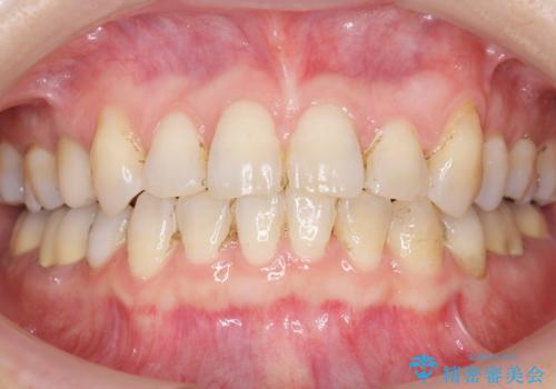 低予算で銀歯を白くしたい 50代女性の治療後
