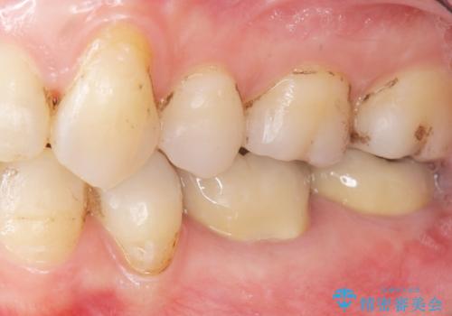 低予算で銀歯を白くしたい 50代女性の治療後