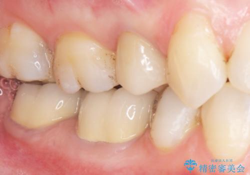 低予算で銀歯を白くしたい 50代女性の症例 治療後