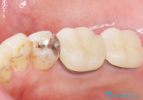 低予算で銀歯を白くしたい 50代女性の治療後