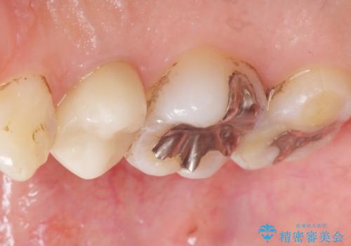 低予算で銀歯を白くしたい 50代女性の治療後