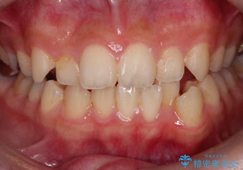 インビザラインで矯正を始めるのオフィスホワイトニングの症例 治療前