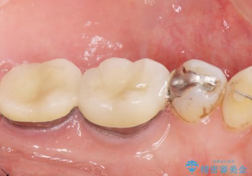 低予算で銀歯を白くしたい 50代女性の治療後