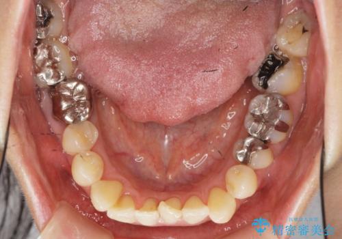 [ 矯正と補綴、総合歯科治療 ]  クロスバイトを避ける前歯部審美ブリッジの治療前