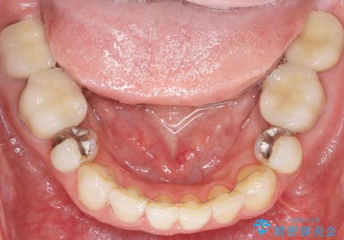 低予算で銀歯を白くしたい 50代女性の治療後