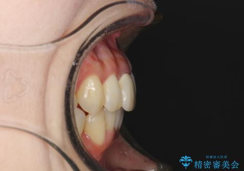 上下のガタガタのマウスピースによる非抜歯矯正の治療後