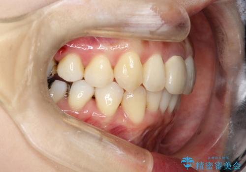 上下のガタガタのマウスピースによる非抜歯矯正の治療後