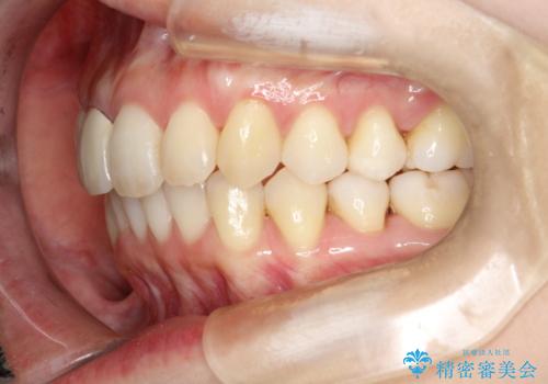 上下のガタガタのマウスピースによる非抜歯矯正の治療後