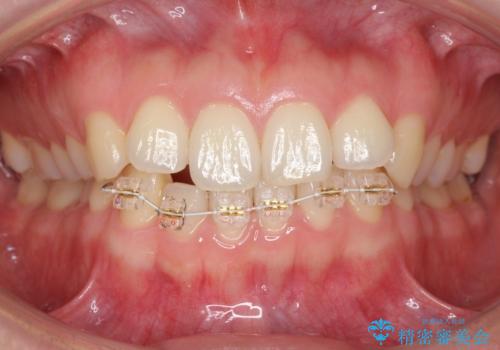 下の前歯が1本短い インビザラインと部分矯正の組み合わせの治療中