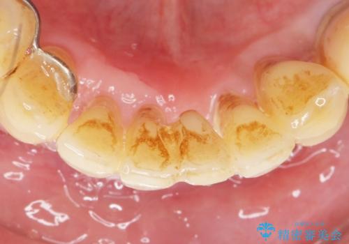 他院で抜歯と言われた歯 歯も神経も残したい 50代男性の治療中