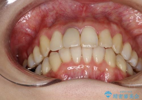 上下のガタガタのマウスピースによる非抜歯矯正の治療後