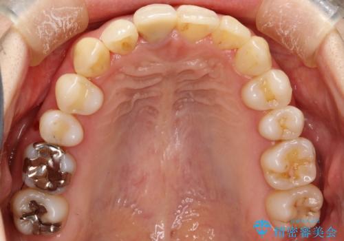上下のガタガタのマウスピースによる非抜歯矯正の治療後