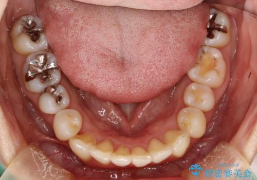 上下のガタガタのマウスピースによる非抜歯矯正の治療後