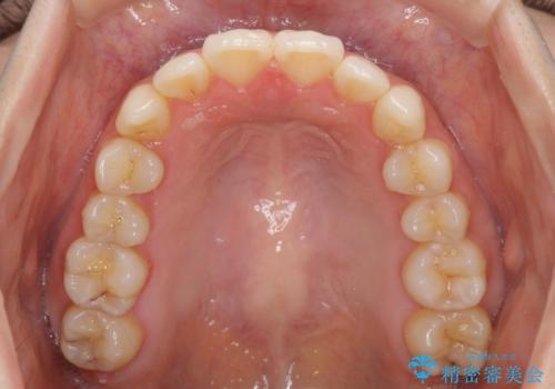 インビザラインを用いた非抜歯矯正の治療中