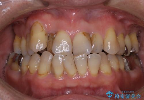 全体的な治療の開始前に着色取りの治療前