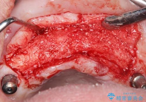 喫煙を再開してインプラント周囲炎に リカバリー治療 50代男性の治療中