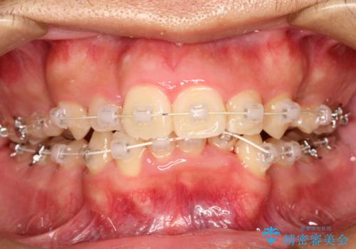 重度のガタガタ ワイヤーによる抜歯矯正の治療中