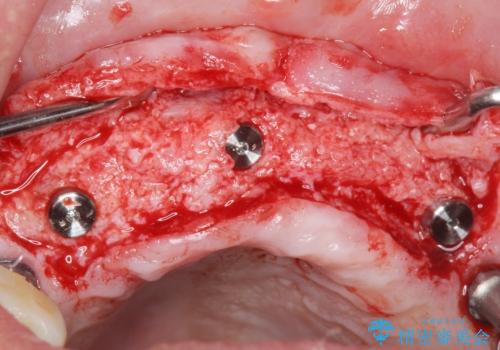 喫煙を再開してインプラント周囲炎に リカバリー治療 50代男性の治療中