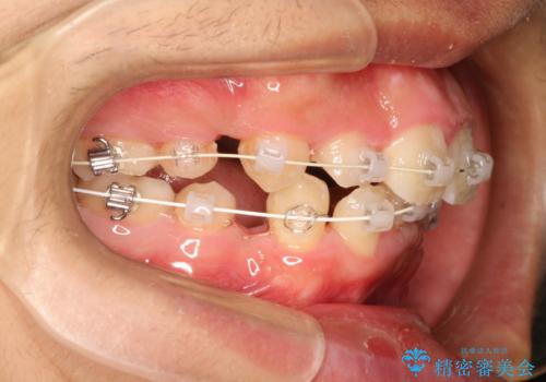 重度のガタガタ ワイヤーによる抜歯矯正の治療中