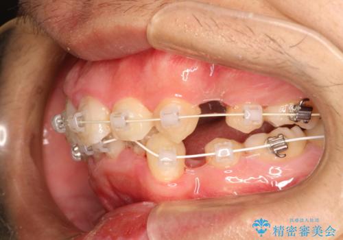 重度のガタガタ ワイヤーによる抜歯矯正の治療中