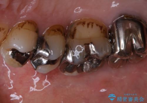 全体的な治療の開始前に着色取りの治療前