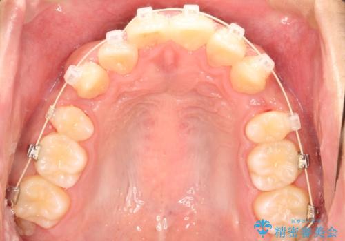 重度のガタガタ ワイヤーによる抜歯矯正の治療中