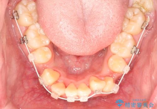 重度のガタガタ ワイヤーによる抜歯矯正の治療中